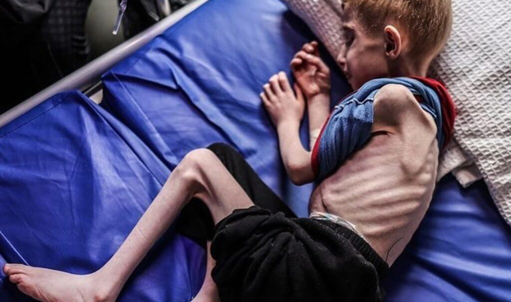 Videos of malnourished children show Gaza’s forced starvation crisis Videos of malnourished children show Gaza’s forced starvation crisis