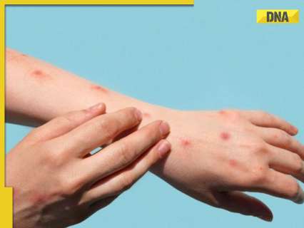 Mpox Outbreak: Bengaluru airport on high alert, testing, 21-day quarantine now mandatory for… Mpox Outbreak: Bengaluru airport on high alert, testing, 21-day quarantine now mandatory for…