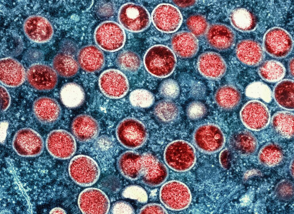 India records first suspected mpox case, male patient in isolation India records first suspected mpox case, male patient in isolation