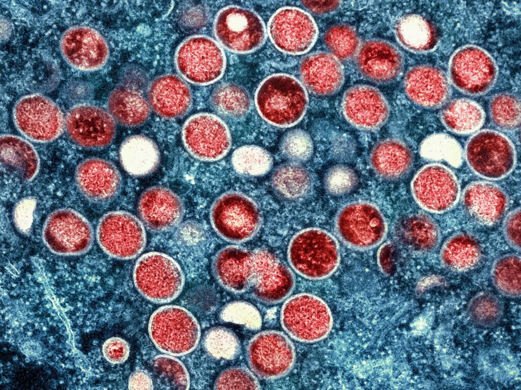 Sierra Leone declares emergency over mpox outbreak Sierra Leone declares emergency over mpox outbreak