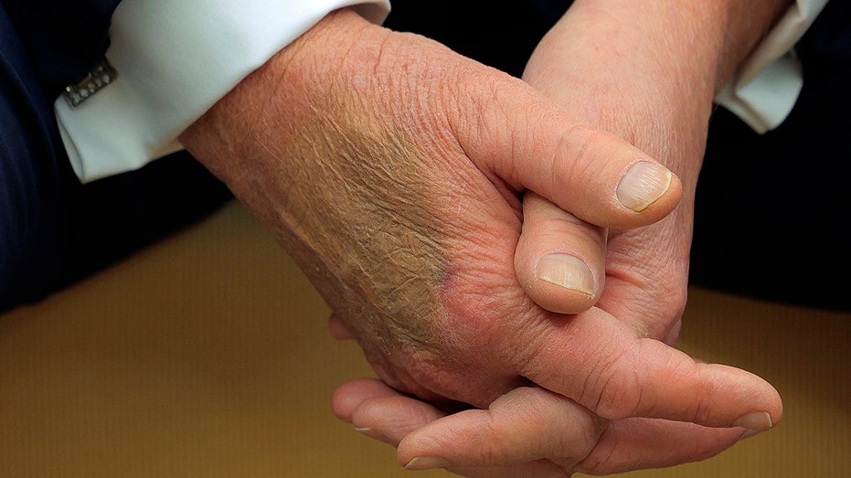 White House explains bruise on Trump’s hand seen during Macron meeting White House explains bruise on Trump’s hand seen during Macron meeting