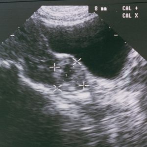 Ectopic pregnancy deaths have nearly doubled. It’s worse in states, like Texas, with abortion bans.