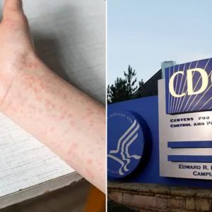 Texas measles cases are underreported, response hurt by funding cuts, CDC scientist says