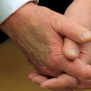 White House explains bruise on Trump’s hand seen during Macron meeting
